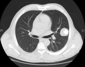 Pulmonary mass in the left upper lobe, 4.9×4.1cm.