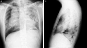 Right pneumothorax. Diffuse bilateral nodular interstitial patter, with millimetric nodules, coalescing to form pseudocondensations. Left diaphragmatic plication.