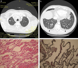 Volumetric reconstruction bone filter HRCT of the upper (a) and lower lung lobes (b) showing multifocal smooth interlobular septal tickening (white arrows) and bilateral mild pleural effusion (black arrows). Histopathological features (c) included thickening of interlobular septa and alveolar walls, filled by a growing proliferation of thin-wall blood vessels with little areas of lymphocytic interstitial inflammation (hematoxylin and eosin staining; magnification 30×). Endothelial cells stain positive with the CD31 monoclonal antibody (d). Magnification 40×.