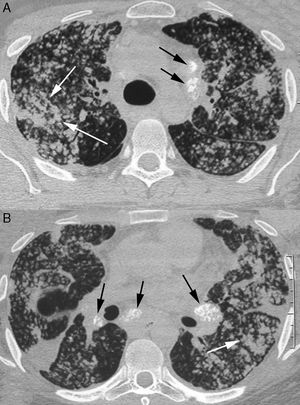 A 29-year-old man with silicoproteinosis. The patient was a sandblaster in the naval industry, with a history of exposure to silica of 2.8 years. CT scans of upper (A) and lower (B) lobes show numerous bilateral airspace nodules, some of them confluent (white arrows) with areas of consolidation in both lungs. Calcified mediastinal and hilar lymph nodes (black arrows) are also evident.