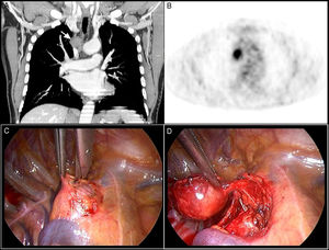 (A) Chest CT-Scan showing a well-defined paratracheal and retrocaval soft lesion, 24mm×26mm, located in the proximity of the azygos vein arch, characterized by medium contrast uptake. (B) 18F FDG-PET scan showing increased spot uptake located in correspondence of the lesion (SUV=5.91). (C) Intraoperative thoracoscopic view; (D) intracapsular enucleation of the lesion after opening the mediastinal pleura.