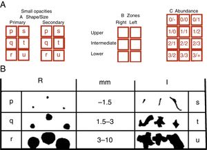 (A) In the ILO reading, reference must be made to the shape and size of lesions, expressed in 2 letters and to lesion profusion, expressed in 2 numbers. The zone of the lung in which the lesions are located must also be indicated. (B) Figure shows small opacities, both round (R) and irregular (I) and nomenclature according to shape and size.