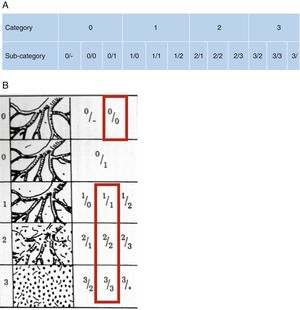 (A) Profusion of lesions on ILO reading is classified into 4 main categories and 12 sub-categories, from least profuse to most profuse. (B) In practice, the more profuse the silicotic lesions, the greater the effacement of pulmonary vessels on chest X-ray.