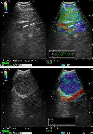 (A) Conventional black and white EBUS B-mode image (left) and with real-time EBUS elastography (right), showing a 6.6mm benign subcarinal lymph node, seen as an area of intermediate rigidity (green). (B) EBUS elastography (right) showing a 12.6mm malignant subcarinal lymphadenopathy, seen as a stiff area (dark blue-cyan), due to squamous cell carcinoma infiltration.