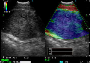 A 20.7mm subcarinal lymphadenopathy seen in B-mode. Real-time EBUS elastography with endoscopic ultrasound shows complete, homogeneous infiltration (blue).
