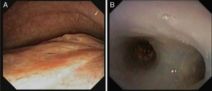 Images before and after placement of the adapted Montgomery stent. (A) Image of malacia in right main bronchus lumen during expiration. (B) Image of the stent, with the entrance to the upper lobe bronchus on the right.