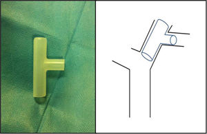 Adapted Montgomery stent.