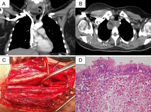 (A and B) CT scan image of the right cervical cyst showing air-fluid levels inside. (C) Surgical image showing dissection of the internal jugular vein and external carotid artery with the bronchogenic cyst pulled back with an Adson clamp. (D) Respiratory epithelium covering the surface of the cyst (H&E 40×).
