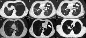 Case 1: A 71-year-old male smoker with giant emphysematous bulla that entirely occupied the left upper lobe (Part A). After endobronchial valve placement in the left bronchus (thin arrow), complete atelectasis of bulla was obtained (thick arrow) with re-expansion of adjacent lung parenchyma (Part B). After 6 months of follow-up, a nodule (*) diagnosed to be a bronchioloalveolar carcinoma was seen in the lower right lobe (Part C). Case 2: A 69-year-old male smoker with emphysema that mostly affected the left upper lobe (Part D). After endobronchial valve placement (thin arrow), complete atelectasis of the treated lobe (thick arrow) was achieved (Part E). After 12 months of follow-up, a solitary pulmonary nodule (thick arrow) diagnosed to be a squamous cell carcinoma was seen in upper right lobe (Part F).