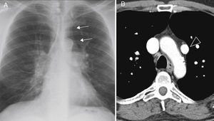 (A) Chest radiograph, posteroanterior view: double density sign on the left mediastinal border (arrows) caused by the ascending path of the defective venous vessel. (B) Contrast-enhanced computed tomography, axial plane: anomalous venous vessel (arrowhead) causing the double density.
