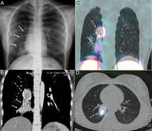 (A) Standard posteroanterior chest X-ray: right basal opacity with signs of atelectasis in right lower lobe (RLL) (arrows). (B) Coronal contrast-enhanced computed tomography (CT): right hilar mass (dotted arrow), enhanced after contrast administration, causing RLL atelectasis (solid arrow). (C) Chest SPECT-CT. Coronal slice: radiotracer hotspot in right hilar region, suggestive of neuroendocrine tumor (dotted arrow). Another less intense radiotracer uptake focus, below the hotspot, located in an area of pneumonitis with atelectasis (solid arrows). (D) Chest SPECT-CT. Axial slice: radiotracer hotspot located in right hilar mass (dotted arrow).