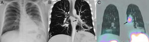 (A) Standard posteroanterior chest X-ray: condensation in left lower lobe (LLL). (B) Coronal computed tomography (CT) with intravenous contrast, volumetric reconstruction: endobronchial mass (arrow) in LLL bronchus with distal pneumonitis and loss of volume. (C) Chest SPECT-CT. Coronal slice: radiotracer hotspot in left parahilar region (arrow).