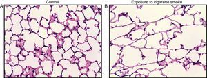 Histological sections (H&E) of the lungs of mice exposed to ambient air (A) and mice exposed to tobacco smoke for 6 months (B), showing emphysema.