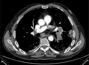 Chest CT slice, showing a filling defect in the pulmonary arteries and the pulmonary mass infiltrating the left pulmonary artery.