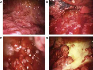 Various thoracoscopic images of malignant pleural mesothelioma. (A) Massive epithelioid malignant mesothelioma invasion of the parietal pleural. (B) Diffuse epithelioid malignant mesothelioma infiltration of parietal and visceral pleura. (C) “String of pearls” nodes in massive epithelioid invasion of the parietal pleural. (D) Pleural plaques and sarcomatous mesothelioma masses in the parietal pleura.