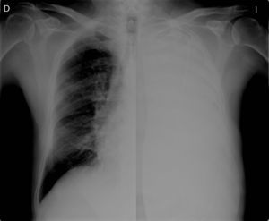 Chest X-ray showing metal guide-wire in the pleural cavity.