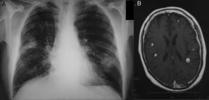 (A) Chest X-ray showing cavitated infiltrate in upper right lobe and infiltrate without cavitation in lower left lobe. (B) Head MRI showing multiple nodular lesions, less than 1cm in size, in the cortical-subcortical region, and vasogenic edema.