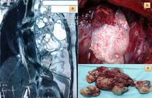 (a) Chest magnetic resonance image of a massive tumor in the left hemithorax, with fat, cystic spaces and organoid structures; (b) perioperative image of the tumor with hair-like structures, and (c) macroscopic image of the fully resected teratoma.