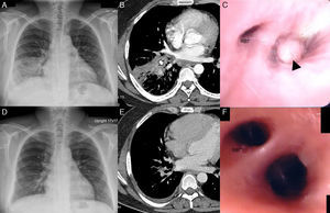 (A) Chest X-ray on initial presentation, in which a mottled ground glass opacity and consolidation at the level of the right lower lobe can be seen. (B) Chest computed axial tomography (CT) image in a mediastinal window setting, showing an area of consolidation at the level of the right lower lobe, with an endobronchial lesion obstructing the basal segmented bronchi (arrow). (C) Bronchoscopy revealed a whitish endobronchial mass (arrow) at the opening of the basal anterior, lateral and posterior segmented bronchi of the right lower lobe. The follow-up chest X-ray (D) and chest CT (E) showed improvement of this lesion. The basal segmented bronchi in the right lower lobe were restored and identified on the chest CT (E) and in the bronchoscopy image (F). RB7: medial basal segmented bronchus of the right lower lobe.