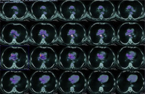 Chest PET-CT image. A large hypermetabolic focus is seen in the subcarinal lymph node station (G7).