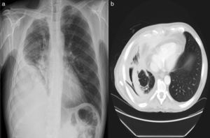 (a) Upper and lower right lobe infiltrates and pleural effusion; (b) right lower lobe atelectasis with pleural effusion.
