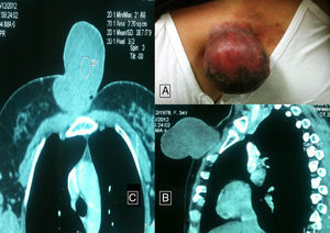 Pedunculated tumor in the anterior chest wall (A). Chest computed tomography showing a pedunculated mass in the chest and right breast, with additional invasion of the chest wall (B and C).