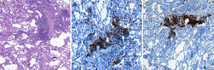 Optical microscopy image of a lung biopsy histological section, showing: (A) good conservation of the alveolar structures of the specimen, as well as the presence of predominantly lymphocytic inflammatory infiltrate located in the interstitium (hematoxylin-eosin, 40×). (B) The immunohistochemical study shows the presence of T lymphocytes (CD3 labeling; 100×) and (C) B lymphocytes (CD20 labeling, 100×). The patient was diagnosed with lymphocytic interstitial pneumonia, with no evidence of lymphoma.