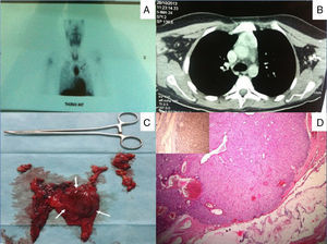 (A) Preoperative 99mTc-MIBI scan showing a large area of increased uptake in the mediastinum. (B) Chest computed tomography showing a large mass in the area of the anterior thymus. (C) Postoperative image after complete thymectomy showing the parathyroid adenoma occupying almost all the left thymus lobe. (D) Postoperative histopathology examination showing parathyroid adenoma surrounded by normal thymus tissue. Immunostaining positive for parathyroid hormone (inset).