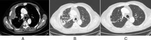 (A) Pulmonary mass in the peripheral right upper lobe (RUL) of necrotic and abscessed appearance, containing a small air bubble (mediastinal window CT image). (B) Previously described nodule has disappeared, and a new cavitated nodule has appeared close by. Bronchial wall thickening and RUL bronchial impaction (lung window CT image). (C) Resolution of previous findings (follow-up lung window CT image).
