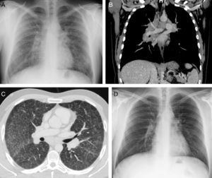 Chest X-ray (A) showing a widened mediastinum, enlarged pulmonary hila and interstitial involvement. Chest computed tomography confirming presence of large mediastinal lymphadenopathies, and bilateral hilar (B, coronal reconstruction with intravenous contrast medium) and pulmonary parenchymal (C, axial image in lung window) involvement. Chest X-ray (D) obtained 6 months after starting corticosteroid treatment showing normalization of findings.