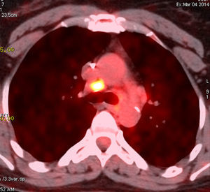 18 FDG PET/CT image showing intense hypermetabolism (SUVmax=5.1) of the mediastinal lymph node in case 2.