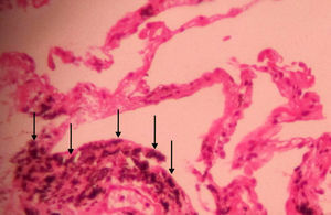 Section from lung transbronchial biopsy reveals anthracotic deposits (arrows) in peribronchovascular bundles as well as interlobular septa with no evidence of fibrosis (hematoxylin and eosin staining, original magnification 400×).