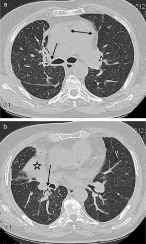 A 64-year-old male with cough and dyspnea. (a) CT image at the level of main pulmonary artery shows the central peribronchial soft tissue thickening (arrow) and narrowing of RUL bronchus. Also noted is the enlargement of main pulmonary artery (double head arrow). (b) Chest CT with lung window reveals the collapse of RML (star) as well as RLL peribronchial soft tissue thickening (arrow) with obliteration of the apical segmental bronchus of the right lower lobe.