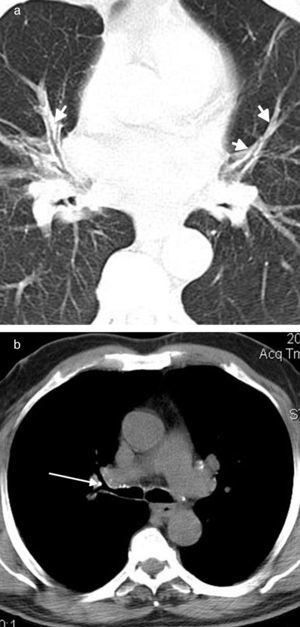 A 58-year-old male with cough and dyspnea. (a) CT with lung window demonstrates multiple bilateral intraparenchymal peribronchial cuffing (arrows). (b) Chest CT shows right-sided segmental calcified lymph node with pressure effect on adjacent bronchus (arrow).