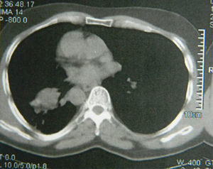 Chest computed tomographpy showing segmentary atelectasis extending from the right lower lobe to the right middle lobe.