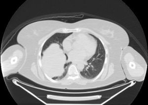 Computed axial tomography.