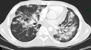 High resolution computed tomography of the chest showing bilateral nodules with irregular margins, ground glass opacities and peribronchial cuffing.