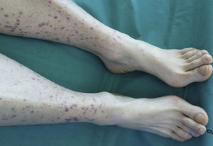 Palpable purpura lesions on the legs and nail clubbing in the toes.