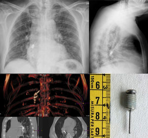 The upper images show the chest X-ray with the drill bit in the bronchus intermedius. In the lower figures, the chest CT can be seen on the left and the foreign body extracted is shown on the right.