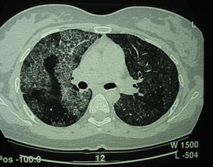 High-resolution computed tomography of a patient with pulmonary alveolar proteinosis (PAP) showing typical characteristics of interlobular septal thickening against a background of ground-glass opacities, producing the distinctive crazy paving appearance.