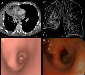 Extensive consolidation of the middle lobe can be observed, containing air bubbles (A), and distortion of the right bronchial anatomy (B). Correlation between virtual reconstruction and optical bronchoscopy showing tapering of the airway lumen of the middle lobe bronchus (C and D).