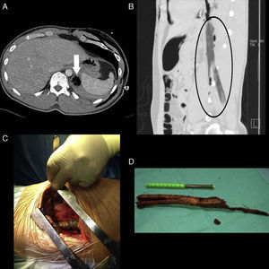 Chest-abdominal computed tomography (A–B) showing a piece of wood, 20cm long and 2cm thick, with two distal ends (inverted Y-shape), extending in a craniocaudal direction from the left crus of the diaphragm to the psoas and left posterior paravertebral muscle. Surgical field images, showing the tree branch in the thoracic cavity (C) and the foreign body (D) after extraction under direct visual control.
