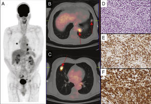 Whole-body maximum intensity projection (MIP) 18F-FDG PET image (A) and axial fused PET/CT images (B, C) showed several areas of increased 18F-FDG uptake corresponding to bilateral pulmonary nodules (arrows). Histology of a pulmonary nodule showed the presence of interstitial infiltration of small-medium size lymphoid elements with clear cytoplasm (D). By immunohistochemistry the tumor cells expressed CD3 (E) and CD4 (F). The final diagnosis was lung involvement of mycosis fungoides.