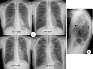 (a) Chest radiograph (posterior anterior view), showing evolution of pleuroparenchymal fibroelastosis, characterized by progressive loss of volume in upper lobes, upper bilateral hilar retraction, and biapical pleural thickening. (b) Chest radiograph (lateral view), showing flattened thoracic cage; note how the anterior posterior diameter of the chest (arrow) has narrowed relative to the craniocaudal diameter.