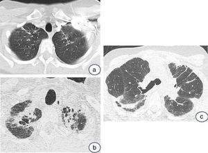 High resolution computed tomography (HRCT), showing evolution of the above case over a period of 2 years and 2 months. The top image (a) shows only a few discrete elongated opacities in both apices; the lower image (b) shows loss of volume and pleuroparenchymal fibrotic infiltrates. (c) Shows an HRCT slice at the level of the tracheal carina. The image shows architectural distortion, with pleural thickening and elongated fibrotic parenchymal opacities (lung window).