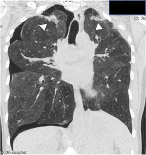High resolution computed tomography (HRCT). This coronal reconstruction shows a right sided pneumothorax and fibrotic infiltrates in both apices (head of arrow).