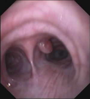 Fiberoptic bronchoscopy, showing the lesion in the right main bronchus.