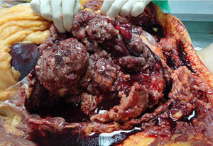 Image of the thoracic cavity during autopsy: multiple nodular neoplastic implants are seen in the visceral pleura, along with a moderate amount of serous, bloody pleural fluid.