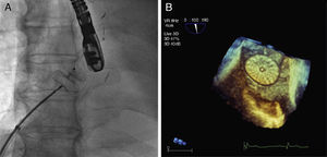 Spectroscopy image in hemodynamics unit. Unfolded Amplatzer® Cribriform 25mm occluded before release in the interatrial septum (A). Transesophageal echocardiogram 3-dimensional image showing device after percutaneous closure of the PFO (B).