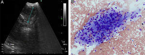 (A) Endobronchial ultrasound view of the suspicious lesion. (B) Granulomatous formation (hematoxylin–eosin staining ×200).